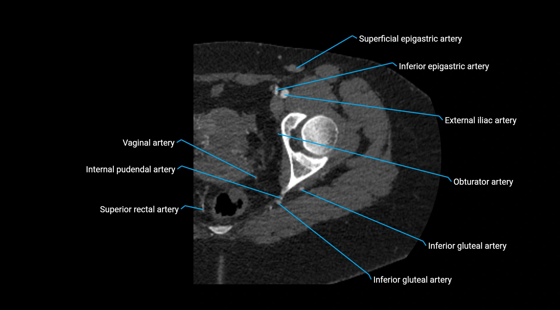 CTA lower limb cross sectional anatomy labelled image _52.webp